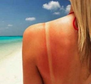 prevenir arrugas, quemaduras de sol, cuidados de la piel